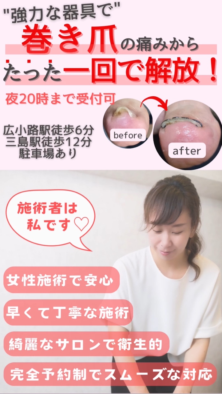 巻き爪